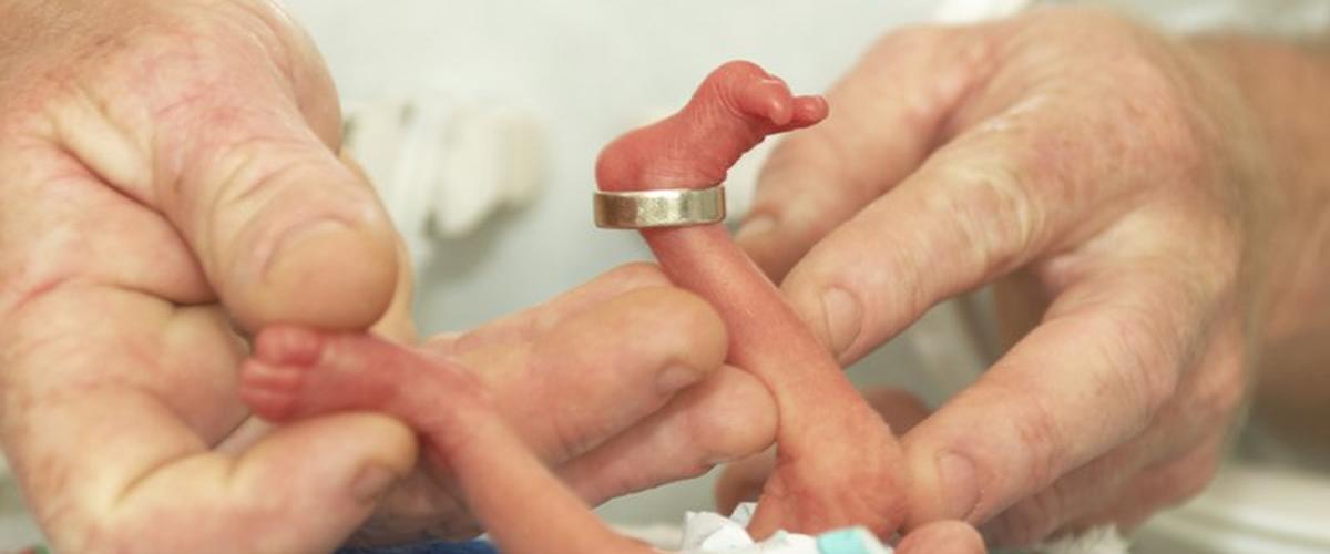 بريطانيا: ولادة طفلة بحجم هاتف أيفون